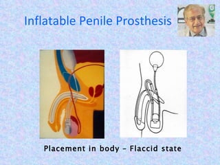 Inflatable Penile Prosthesis Placement in body – Flaccid state 