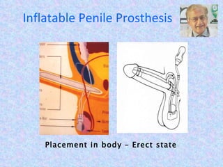Inflatable Penile Prosthesis Placement in body – Erect state 