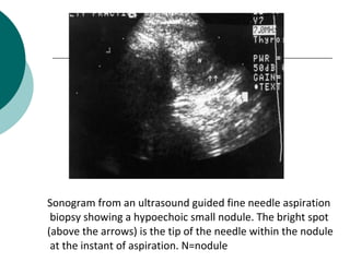 Sonogram from an ultrasound guided fine needle aspiration
 biopsy showing a hypoechoic small nodule. The bright spot
(above the arrows) is the tip of the needle within the nodule
 at the instant of aspiration. N=nodule
 