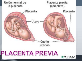 Indicacion De Cesarea
