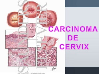 Indicacion De Cesarea