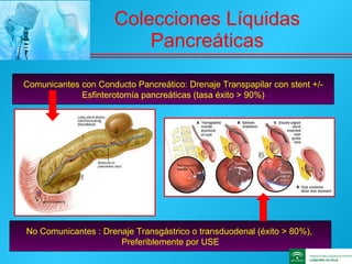 Colecciones Líquidas Pancreáticas Comunicantes con Conducto Pancreático: Drenaje Transpapilar con stent +/- Esfinterotomía pancreáticas (tasa éxito > 90%) No Comunicantes : Drenaje Transgástrico o transduodenal (éxito > 80%),  Preferiblemente por USE 