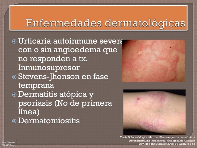 Local immunomodulyatory atopichesky la dermatitis