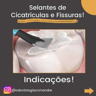 Indicações Selantes de Cicatrículas e Fissuras - Resumo Dentística - Concurso Odontologia.pdf