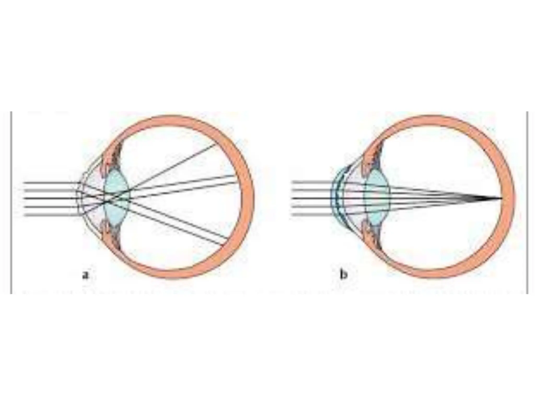 Indication of RGP Lens in corneal abnormalties.pptx