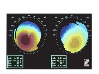 Procornea Rgp Indication of RGP Lens in corneal abnormalties.pptx