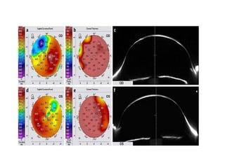 Procornea Rgp Indication of RGP Lens in corneal abnormalties.pptx
