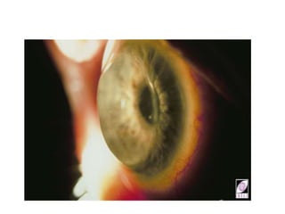 Procornea Rgp Indication of RGP Lens in corneal abnormalties.pptx
