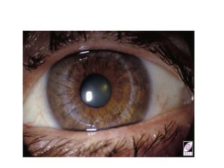 Procornea Rgp Indication of RGP Lens in corneal abnormalties.pptx