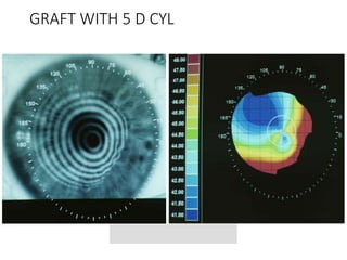 Indication of RGP Lens in corneal abnormalties.pptx