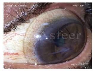 Procornea Rgp Indication of RGP Lens in corneal abnormalties.pptx