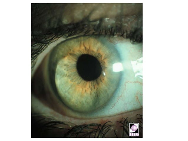 Indication of RGP Lens in corneal abnormalties.pptx