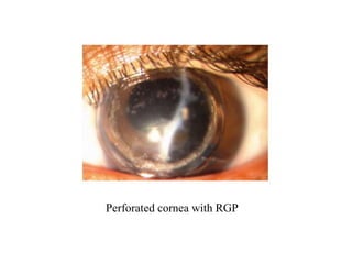 Procornea Rgp Indications and fitting philosophies of therapeutic contact lenses | PPTX