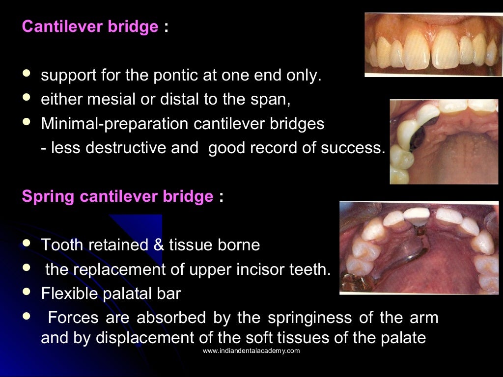 Indications contraindications and classification of bridges/endodonti…