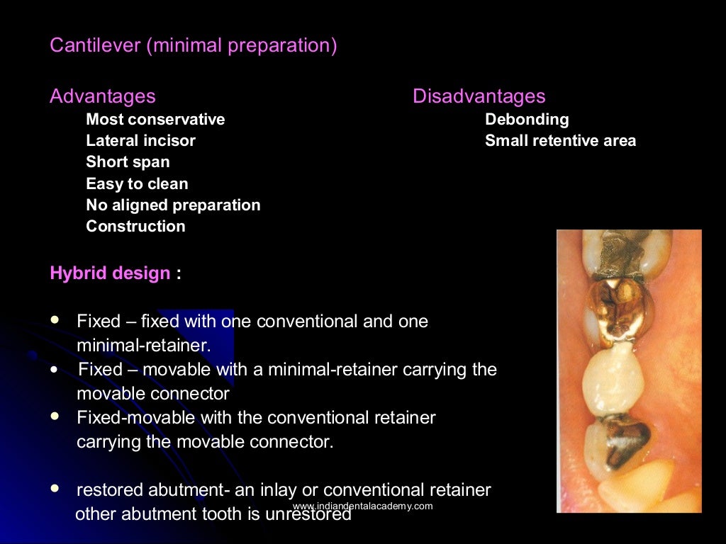 Indications contraindications and classification of bridges/endodonti…