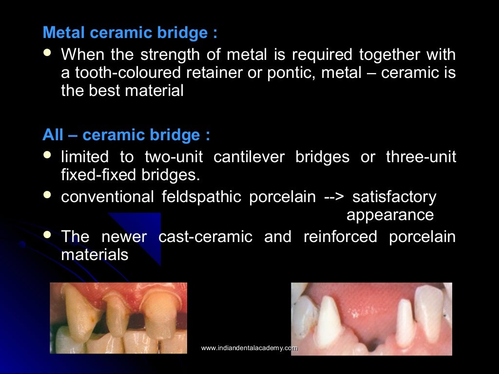 Indications contraindications and classification of bridges/endodonti…