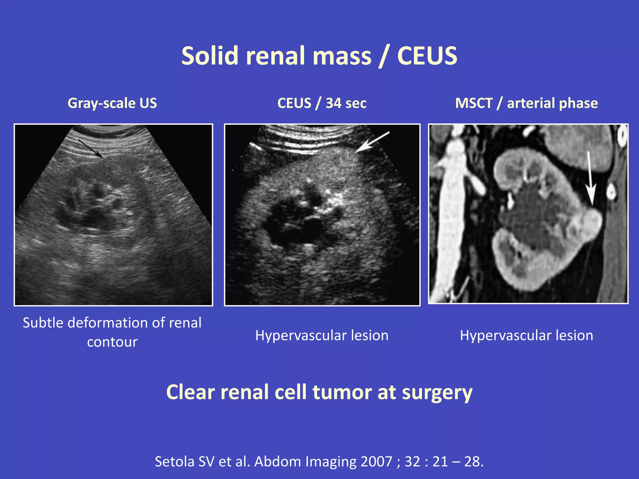 Hypervascular Indications of renal doppler ultrasound 3 | PPTX