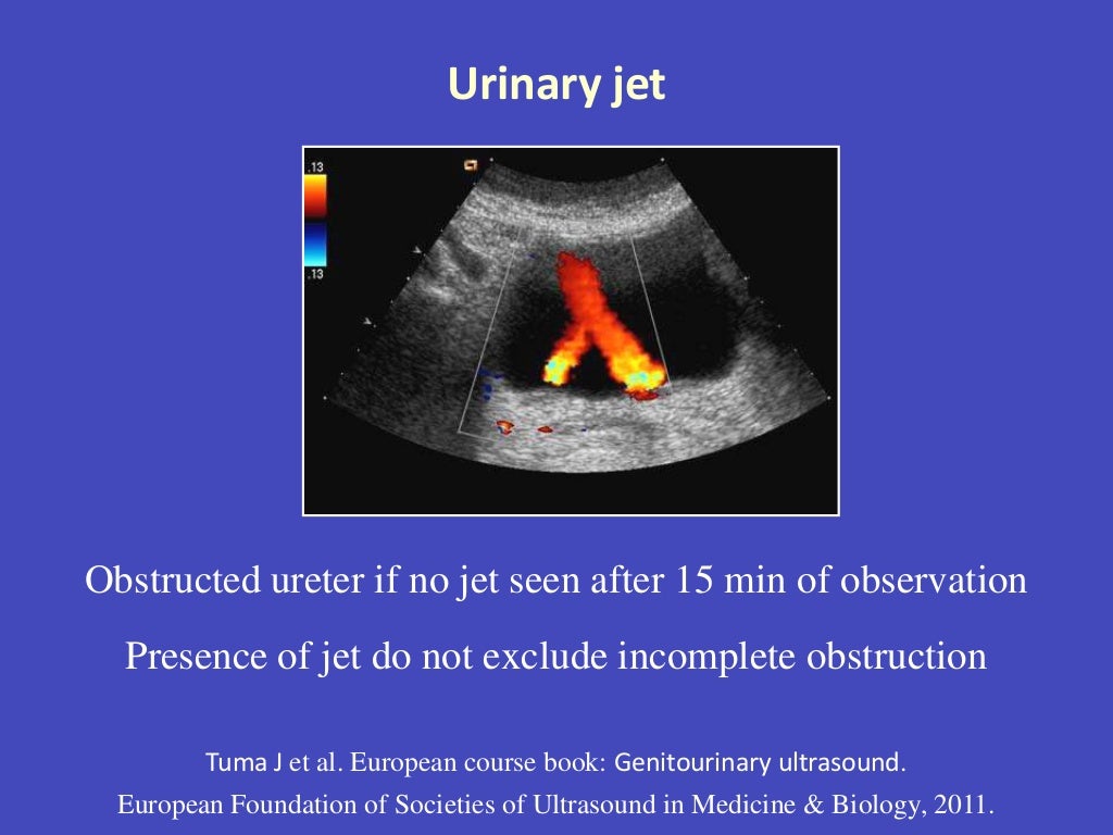 Indications of renal doppler ultrasound 3
