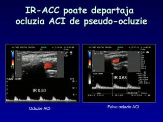 IR-ACC poate departajaIR-ACC poate departaja
ocluzia ACI de pseudo-ocluzieocluzia ACI de pseudo-ocluzie
Ocluzie ACI Falsa ocluzie ACI
IR 0.80
IR 0.68
 