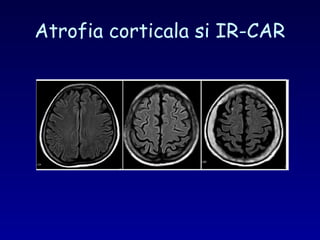 Atrofia corticala si IR-CAR
 