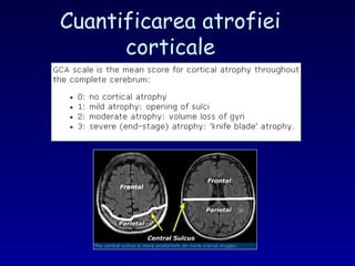 Cuantificarea atrofiei
corticale
 