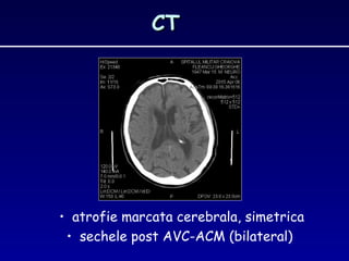 CTCT
• atrofie marcata cerebrala, simetrica
• sechele post AVC-ACM (bilateral)
 