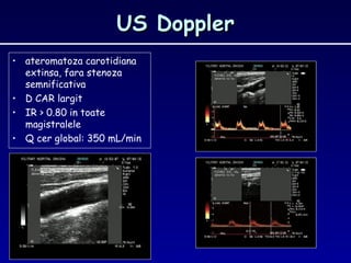 US DopplerUS Doppler
• ateromatoza carotidiana
extinsa, fara stenoza
semnificativa
• D CAR largit
• IR > 0.80 in toate
magistralele
• Q cer global: 350 mL/min
 