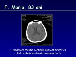 F. Maria, 83 aniF. Maria, 83 ani
• moderata atrofie corticala aparent simetrica
• hidrocefalie moderata compensatorie
 