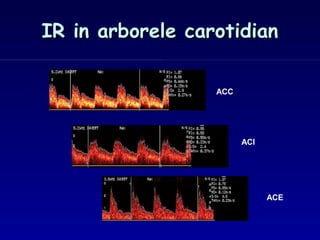 ACC
ACI
ACE
IR in arborele carotidianIR in arborele carotidian
 