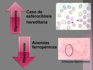 Caso de
esferocitósis
hereditaria
Anemias
ferropénicas
Eritrocitos Hipocrómicos
Hipocromía
Hipercromía
 