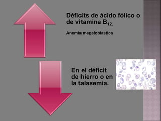 Déficits de ácido fólico o
de vitamina B12.
Anemia megaloblastica
En el déficit
de hierro o en
la talasemia.
 