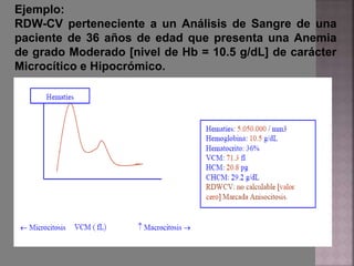 Ejemplo:
RDW-CV perteneciente a un Análisis de Sangre de una
paciente de 36 años de edad que presenta una Anemia
de grado Moderado [nivel de Hb = 10.5 g/dL] de carácter
Microcítico e Hipocrómico.
 