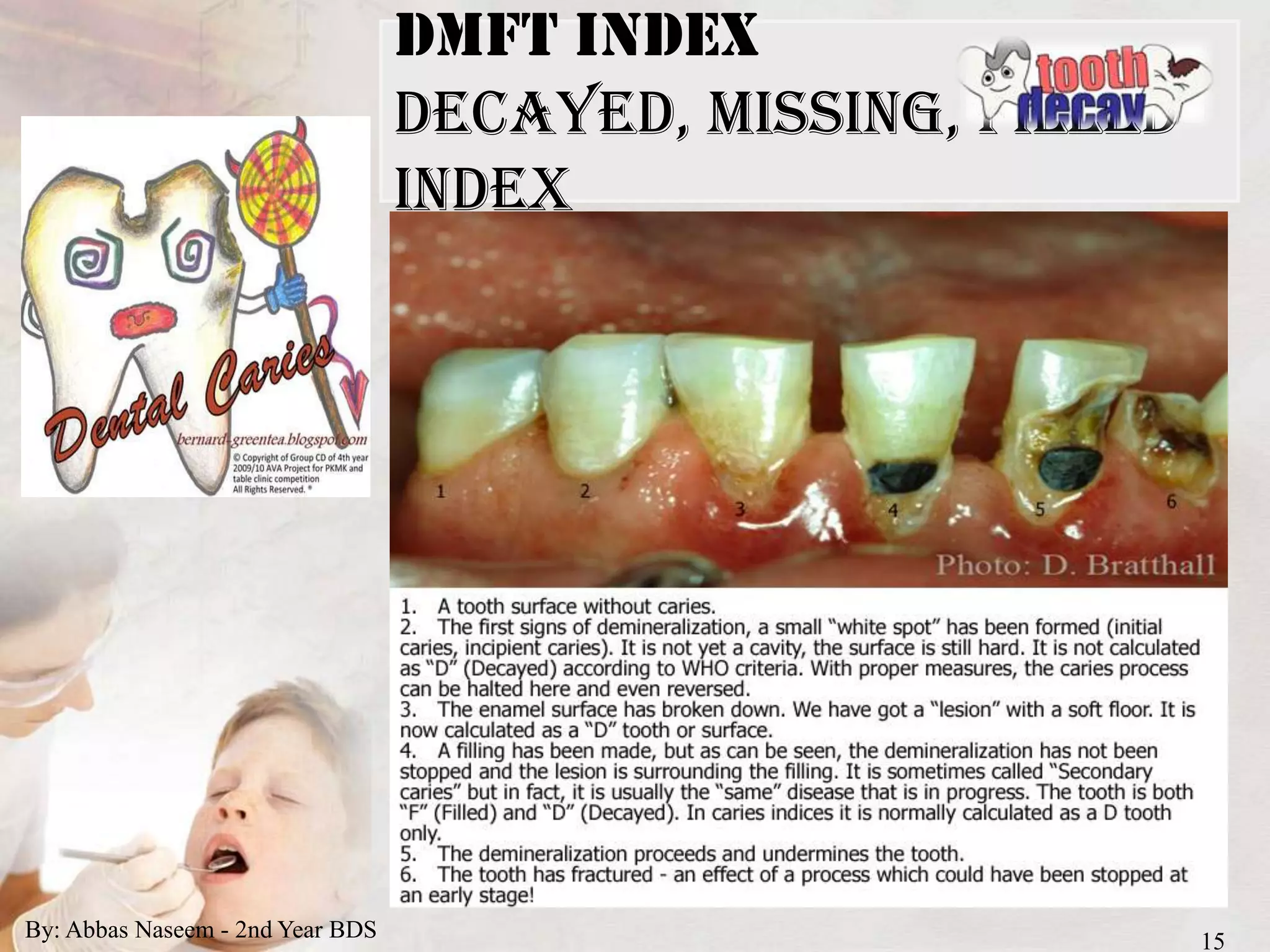 Indices for dental caries | PPTX