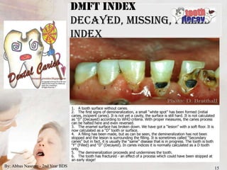 Indices for dental caries | PPTX