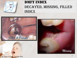 Indices for dental caries | PPTX