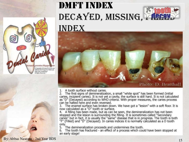 Indices for dental caries