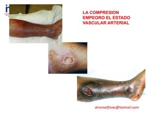 LA COMPRESION
EMPEORO EL ESTADO
VASCULAR ARTERIAL
 