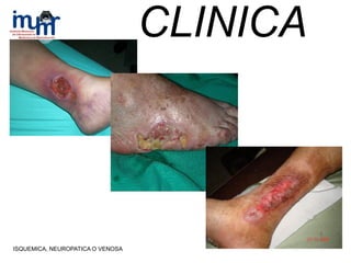 ISQUEMICA, NEUROPATICA O VENOSA
CLINICA
 