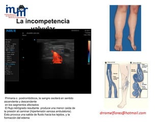 Primaria o postrombóticos, la sangre oscilará en sentido
ascendente y descendente
en los segmentos afectados
El flujo retrógrado resultante produce una menor caída de
la presión al caminar (hipertensión venosa ambulatoria).
Esto provoca una salida de fluido hacia los tejidos, y la
formación del edema
La incompetencia
valvular
 