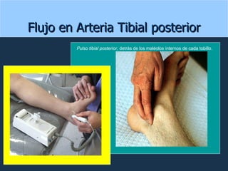 Flujo en Arteria Tibial posterior Pulso tibial posterior , detrás de los maléolos internos de cada tobillo.  