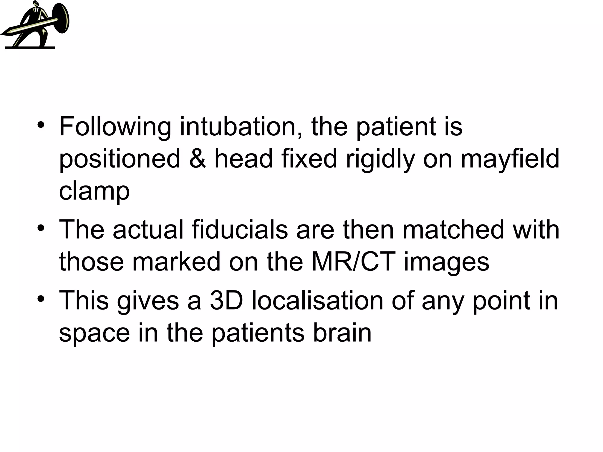Following intubation, the patient is positioned & head fixed rigidly on mayfield clamp The actual fiducials are then matched with those marked on the MR/CT images This gives a 3D localisation of any point in space in the patients brain 