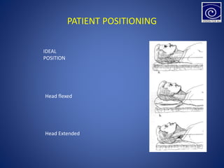 PATIENT POSITIONING
IDEAL
POSITION
Head flexed
Head Extended
 