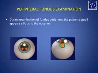 PERIPHERAL FUNDUS EXAMINATION
• During examination of fundus periphery, the patient’s pupil
appears elliptic to the observer
 