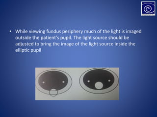 • While viewing fundus periphery much of the light is imaged
outside the patient’s pupil. The light source should be
adjusted to bring the image of the light source inside the
elliptic pupil
 