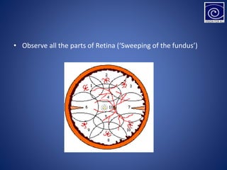 • Observe all the parts of Retina (‘Sweeping of the fundus’)
 