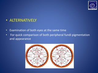• ALTERNATIVELY
• Examination of both eyes at the same time
• For quick comparison of both peripheral fundi pigmentation
and appearance
 