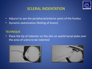 SCLERAL INDENTATION
• Adjunct to see the peripheral/anterior parts of the fundus
• Dynamic examination (Rolling of lesion)
TECHNIQUE
• Place the tip of indenter on the skin on eyelid tarsal plate over
the area of sclera to be indented
 