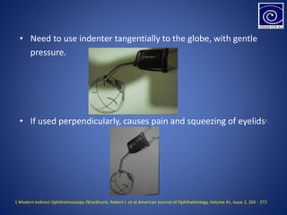 • Need to use indenter tangentially to the globe, with gentle
pressure.
• If used perpendicularly, causes pain and squeezing of eyelids1
1 Modern Indirect Ophthalmoscopy /Brockhurst, Robert J. et al.American Journal of Ophthalmology, Volume 41, Issue 2, 265 - 272
 