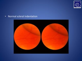 • Normal scleral indentation
 
