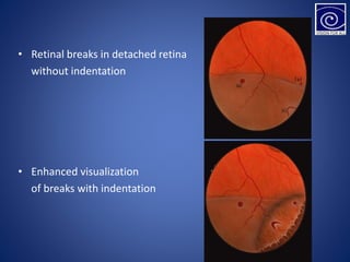 • Retinal breaks in detached retina
without indentation
• Enhanced visualization
of breaks with indentation
 